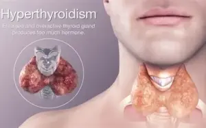 تأثير الغدة الدرقية على زيادة أو نقص الوزن و علاقتها بمنتج HHS A1